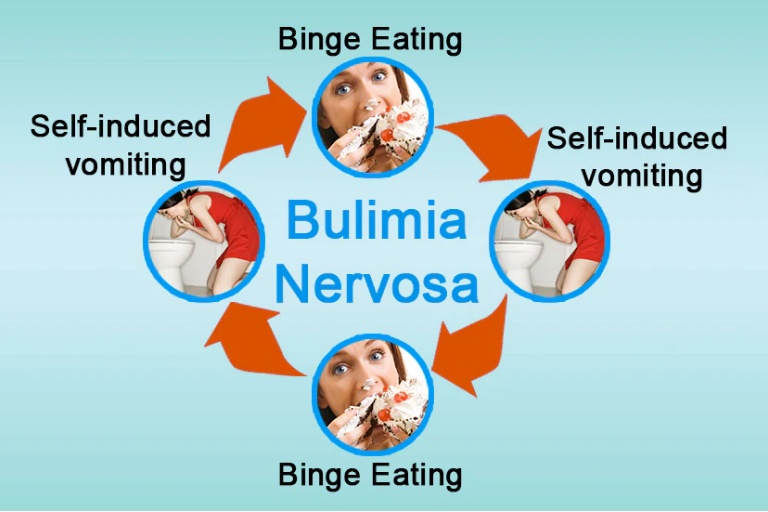 Trị liệu tâm lý cho bệnh nhân Bulimia