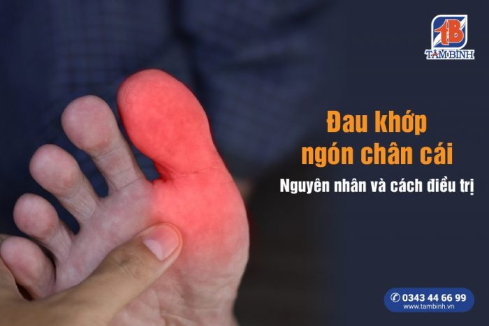 Chườm nóng hỗ trợ giảm viêm khớp
