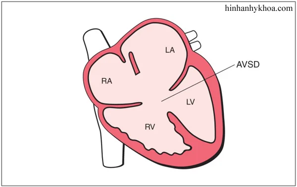 Siêu âm tim chẩn đoán kênh nhĩ thất chung
