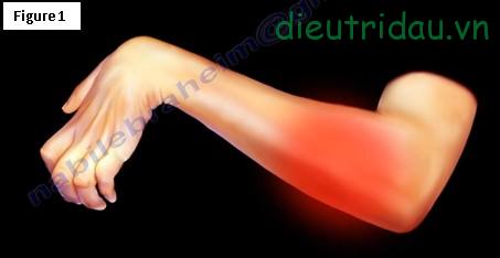 Điều trị co cứng cơ