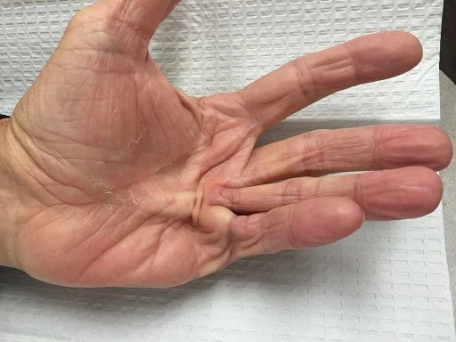 Triệu chứng co rút Dupuytren ở ngón tay