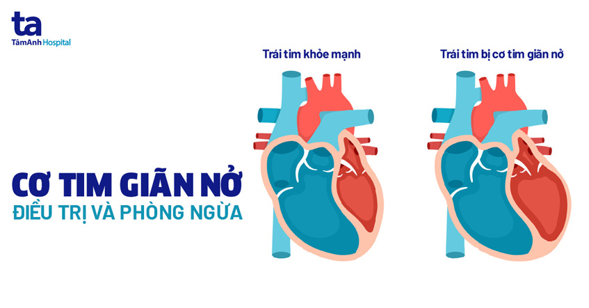 Bệnh cơ tim giãn do Chagas