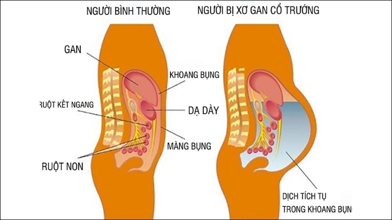 Cổ trướng là gì