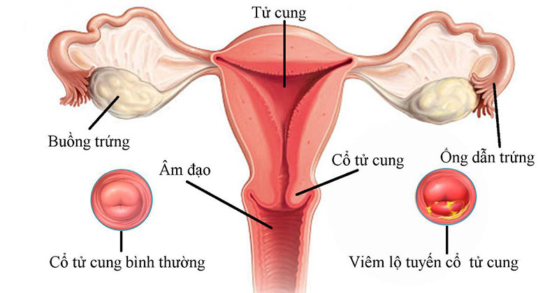 Minh họa co tử cung sớm