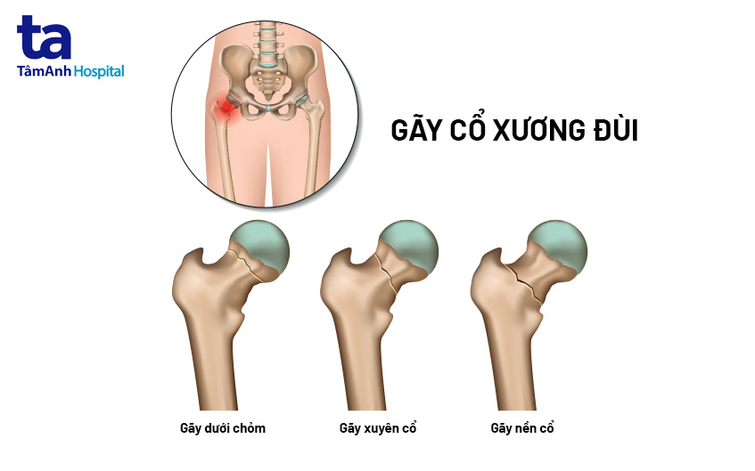 Cấu trúc xương đùi bị gãy