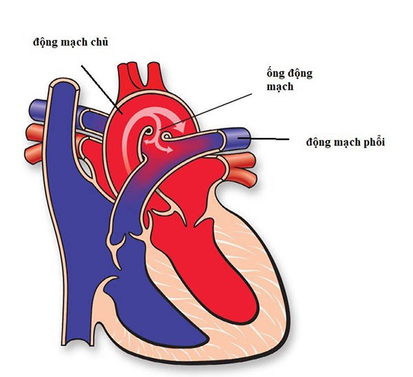 phẫu thuật đóng ống động mạch PDA