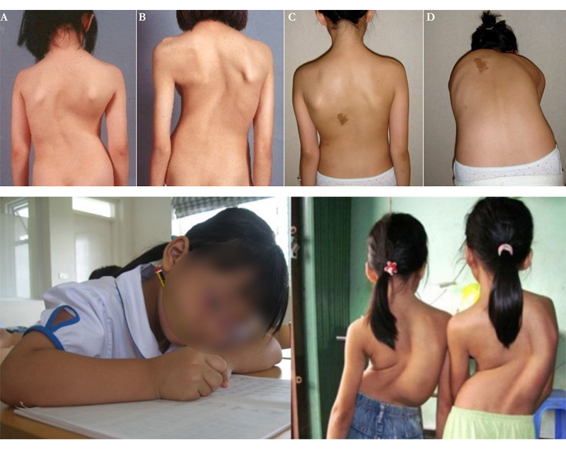 Cong vẹo cột sống ở trẻ em