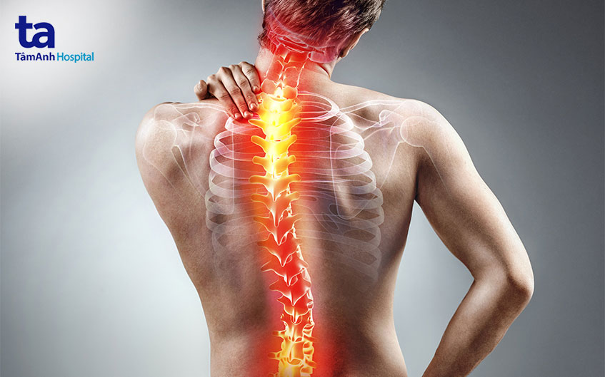 Cong vẹo cột sống gây đau lưng