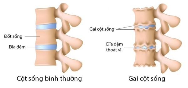 Gai cột sống là gì?