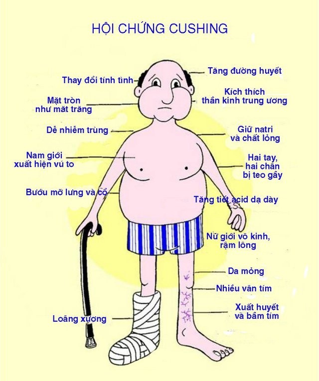 Hình ảnh bệnh nhân hội chứng Cushing