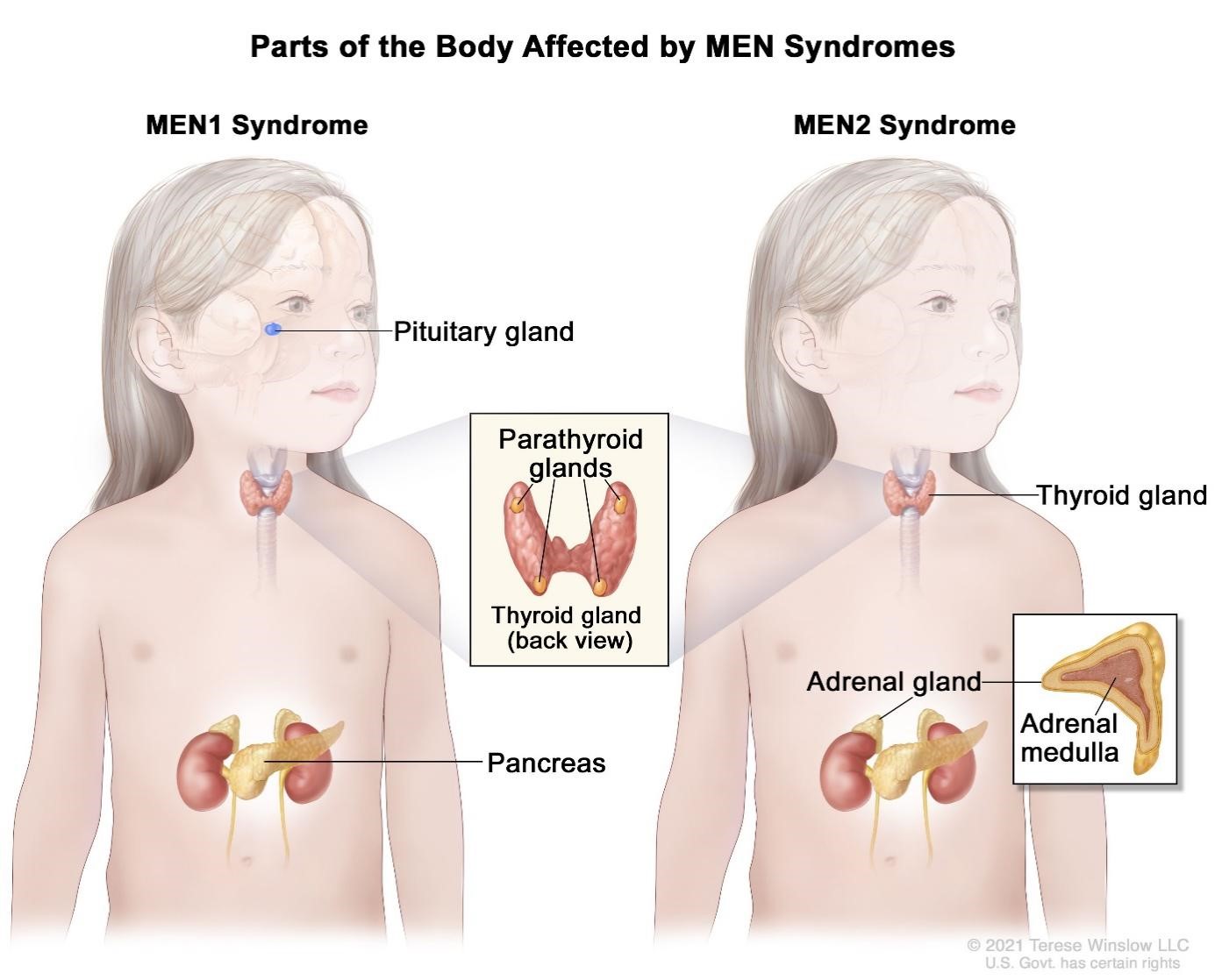 Hội chứng MEN 1 ảnh hưởng nhiều tuyến nội tiết trong cơ thể