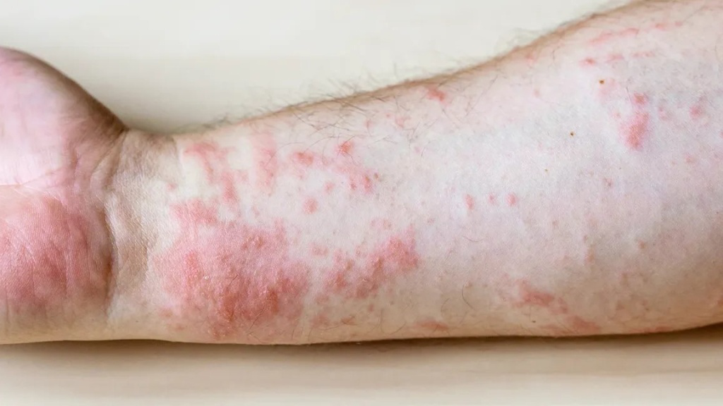 Mẩn đỏ kèm triệu chứng nghiêm trọng