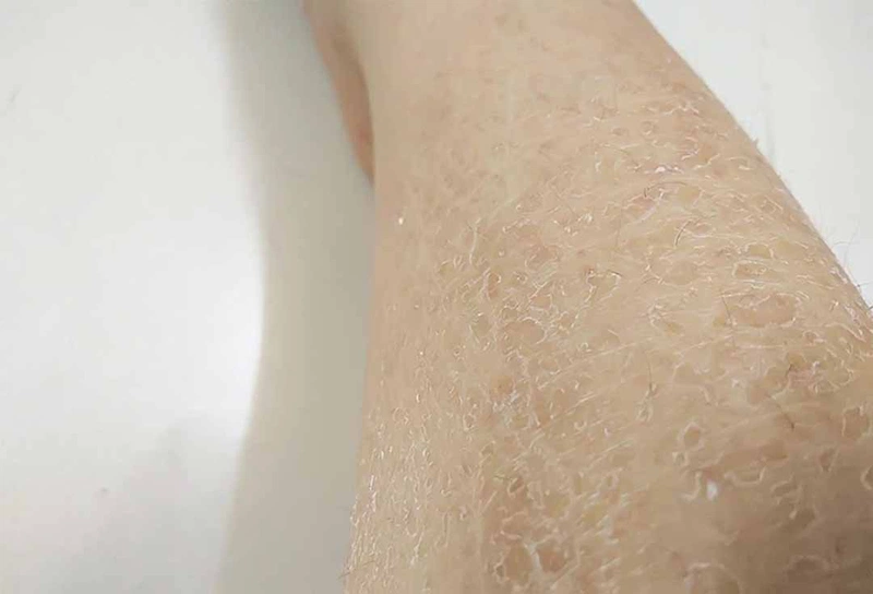 Da đóng vảy bạc ở chân