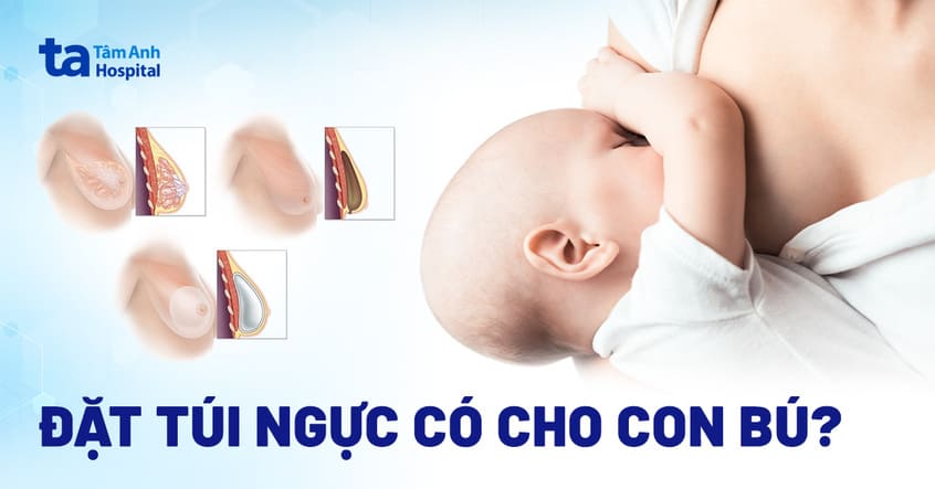 Vị trí đặt túi ngực và tuyến sữa