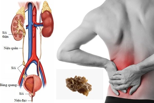 Đau hạ sườn trái do sỏi thận