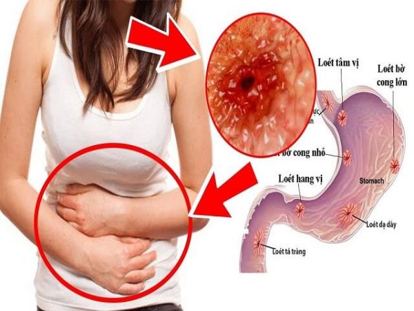 Đau hạ sườn trái do viêm dạ dày