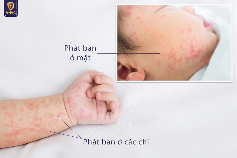 triệu chứng sốt phát ban ở trẻ sơ sinh