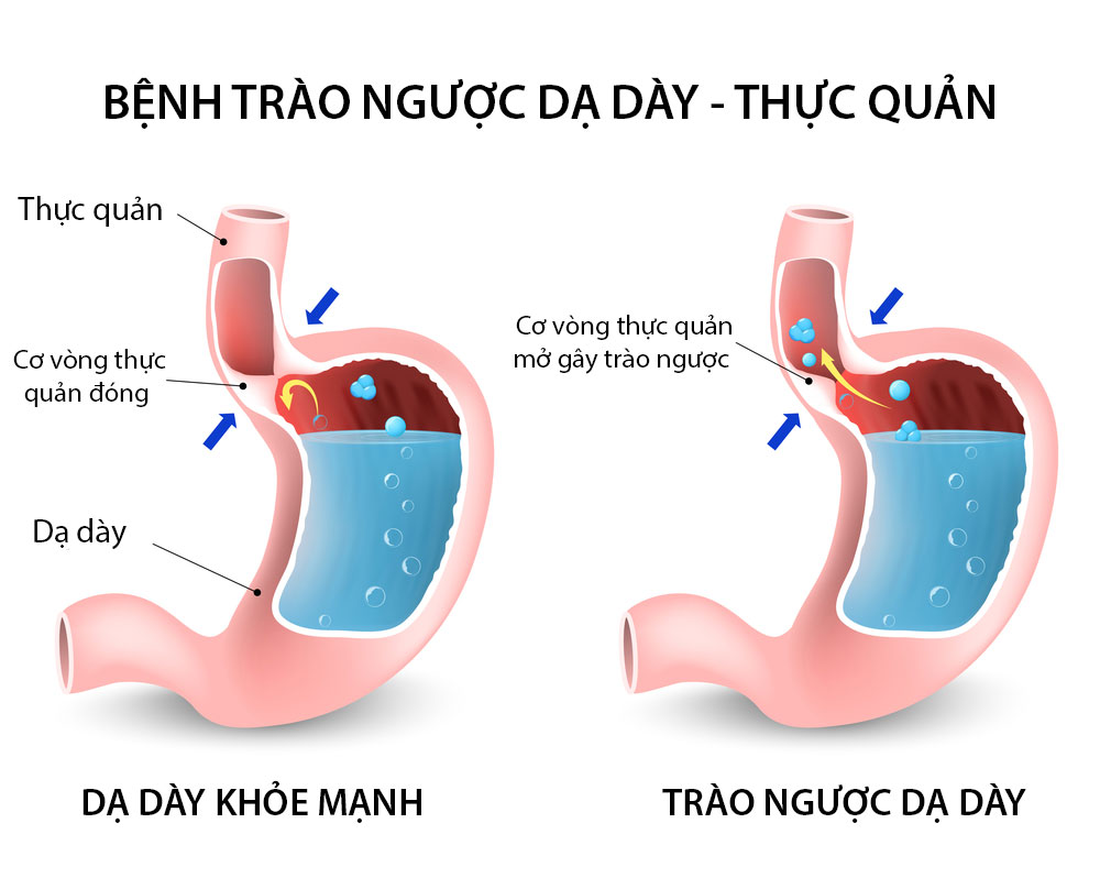 Dấu hiệu bệnh trào ngược dạ dày