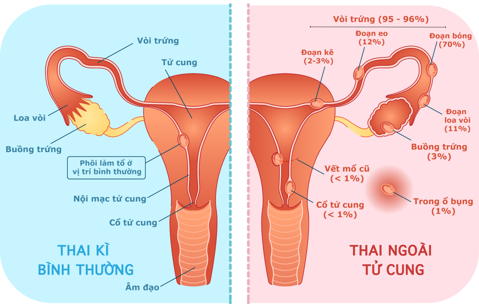 dấu hiệu thai ngoài tử cung