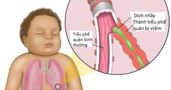 dấu hiệu mềm sụn khí quản