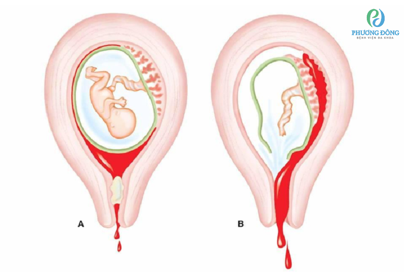Dấu hiệu nhận biết vỡ tử cung