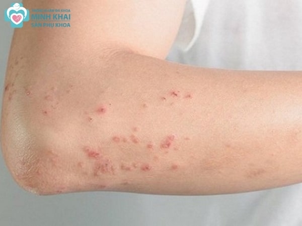 Triệu chứng HIV ban đầu