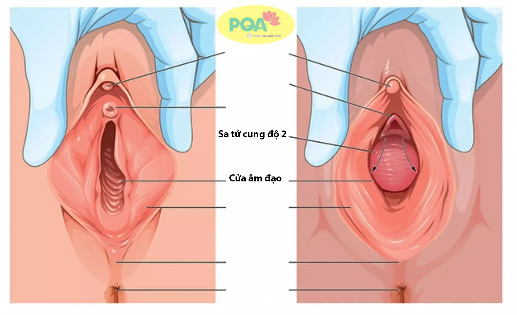 Sa tử cung độ 1