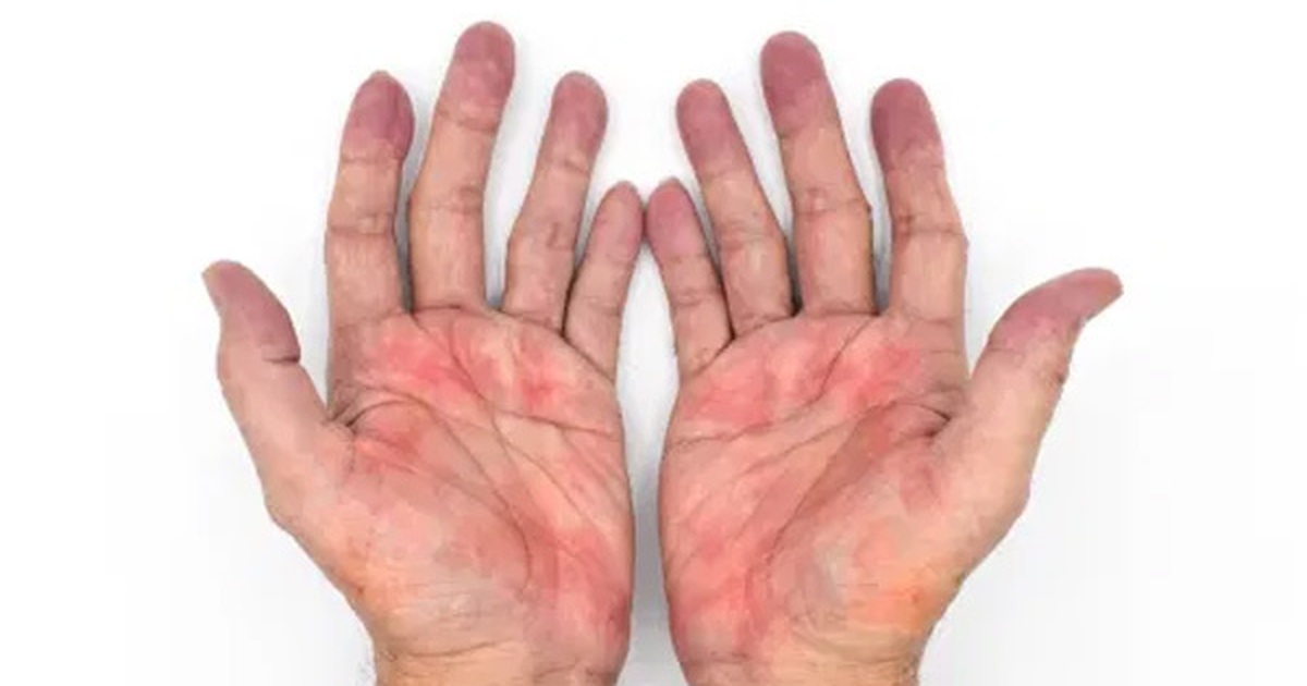 đốm đỏ không đau lòng bàn tay