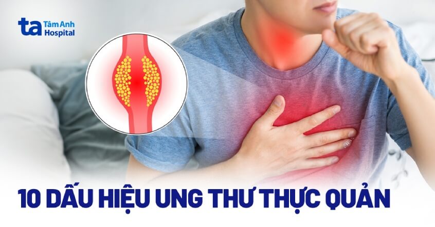 Dấu hiệu ung thư thực quản