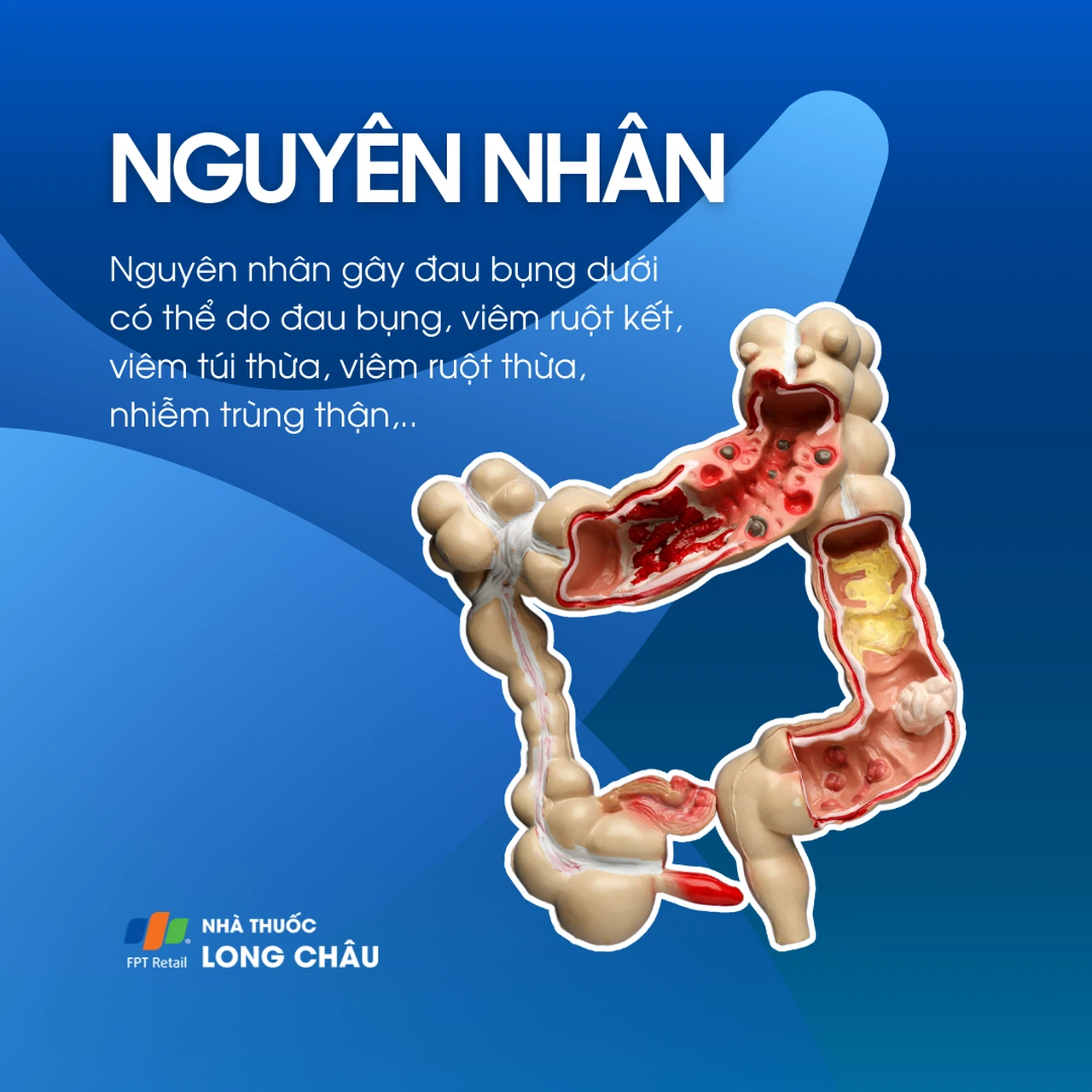 Nguyên nhân đau bụng dưới nam nữ