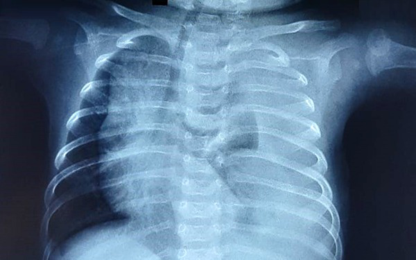 Dấu hiệu nhận biết bệnh màng trong ở trẻ sơ sinh
