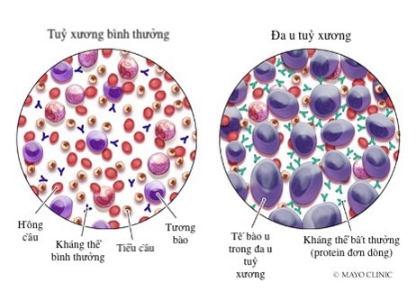 Hình ảnh tổn thương tủy xương trong chẩn đoán plasmacytoma