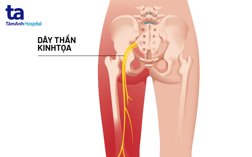 Hình ảnh dây thần kinh tọa