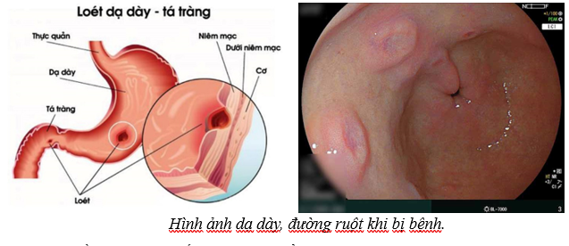 Minh họa vùng da dày bất thường