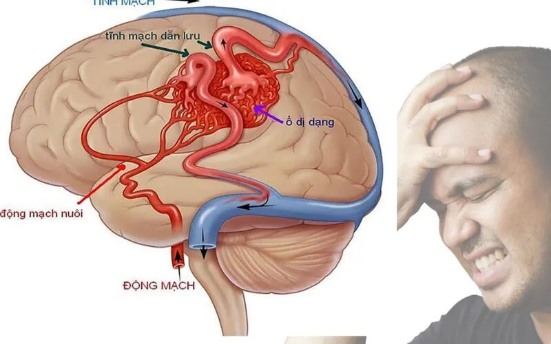 Hình ảnh dị dạng động tĩnh mạch phổi