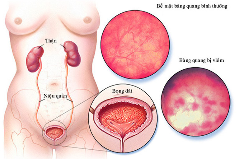 Nguyên nhân gây cảm giác đi tiêu không hết