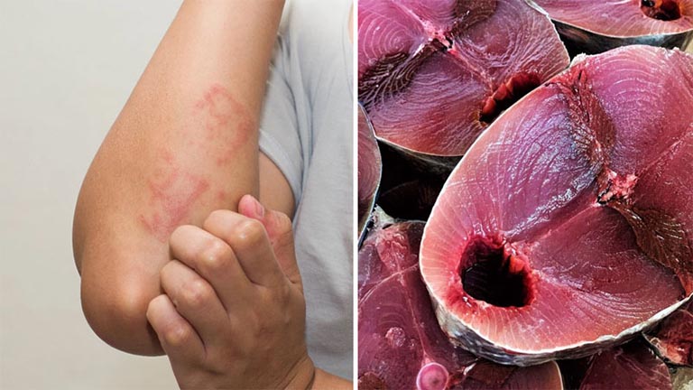 Dị Ứng Cá: Nguyên Nhân, Triệu Chứng Và Cách Xử Trí Hiệu Quả 7 Hình ảnh dị ứng cá ngừ