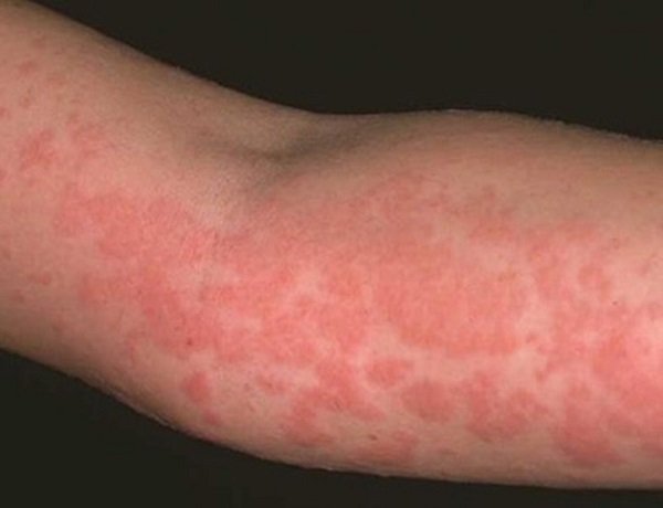 trẻ bị dị ứng lúa mì