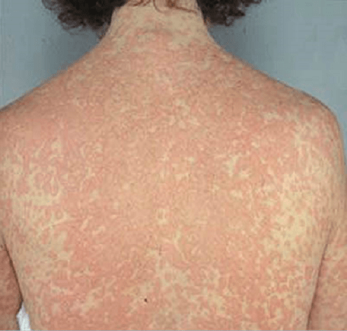 Dị ứng kháng sinh Penicillin có thể gây phát ban, sốc phản vệ