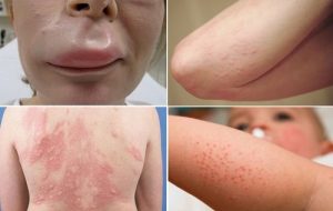 Yếu tố nguy cơ dị ứng Penicillin