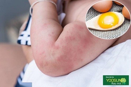 Dị ứng trứng ở trẻ em