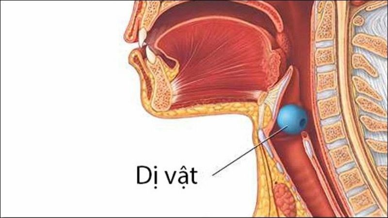 Dị vật đường thở