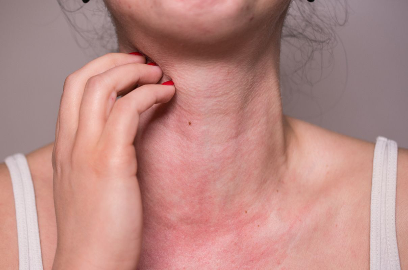 Dị Ứng Cá: Nguyên Nhân, Triệu Chứng Và Cách Xử Trí Hiệu Quả 8 Triệu chứng nổi ban do dị ứng cá