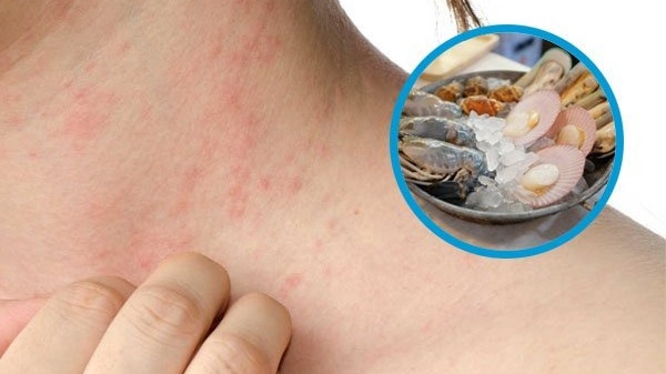 Triệu chứng dị ứng với động vật có vỏ