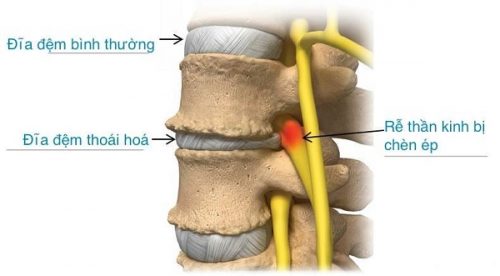 Đĩa Đệm Mất Nước Là Gì? Nguyên Nhân, Triệu Chứng & Cách Điều Trị Hiệu Quả 7 hình ảnh đĩa đệm bị khô nước