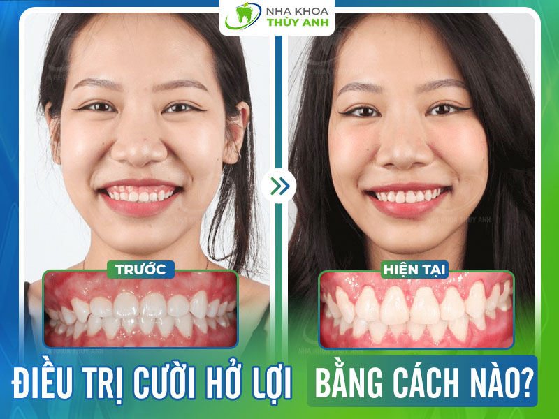 Điều trị cười hở lợi