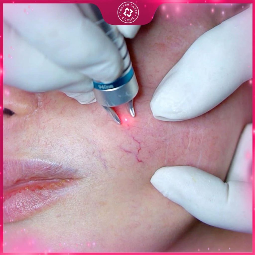 Laser mạch máu: Giải pháp hiệu quả cho giãn mao mạch và da đỏ 7 Laser điều trị giãn mao mạch