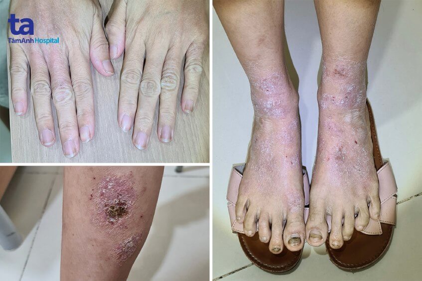 Điều trị vết loét tay chân