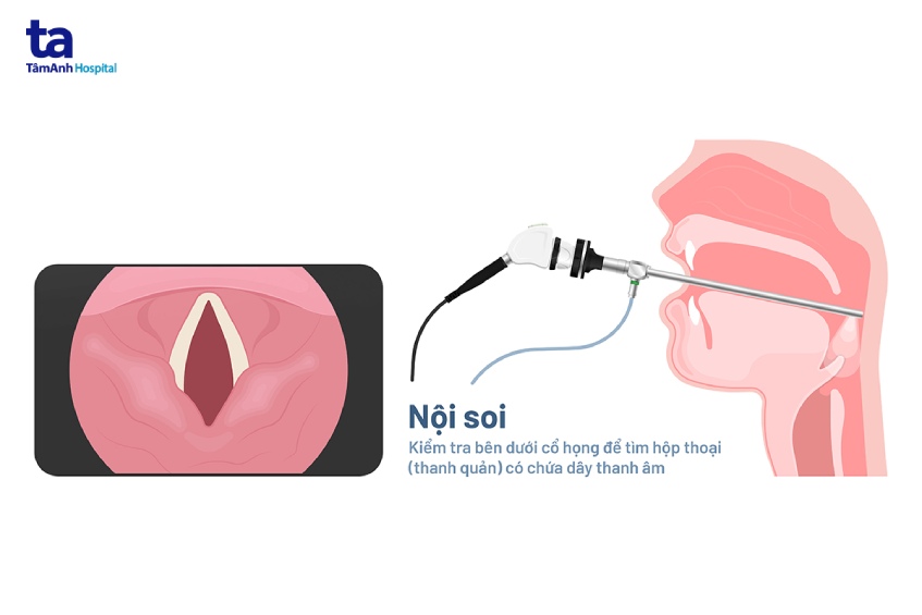 Điều trị liệt dây thanh bằng can thiệp nội soi