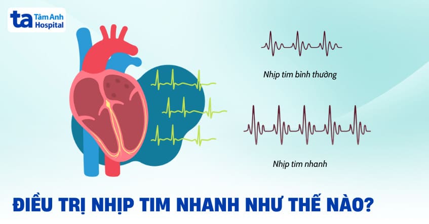 Điều trị nhịp tim nhanh